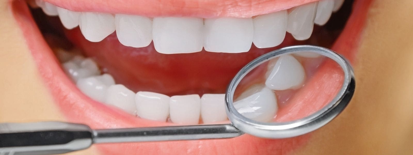 image-Mar-20-2025-04-07-12-4178-PM Dental Crowns