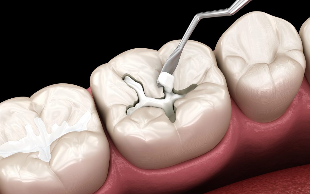 Dental Sealants for Molars: Guard Hard-to-Reach Surfaces with Ease