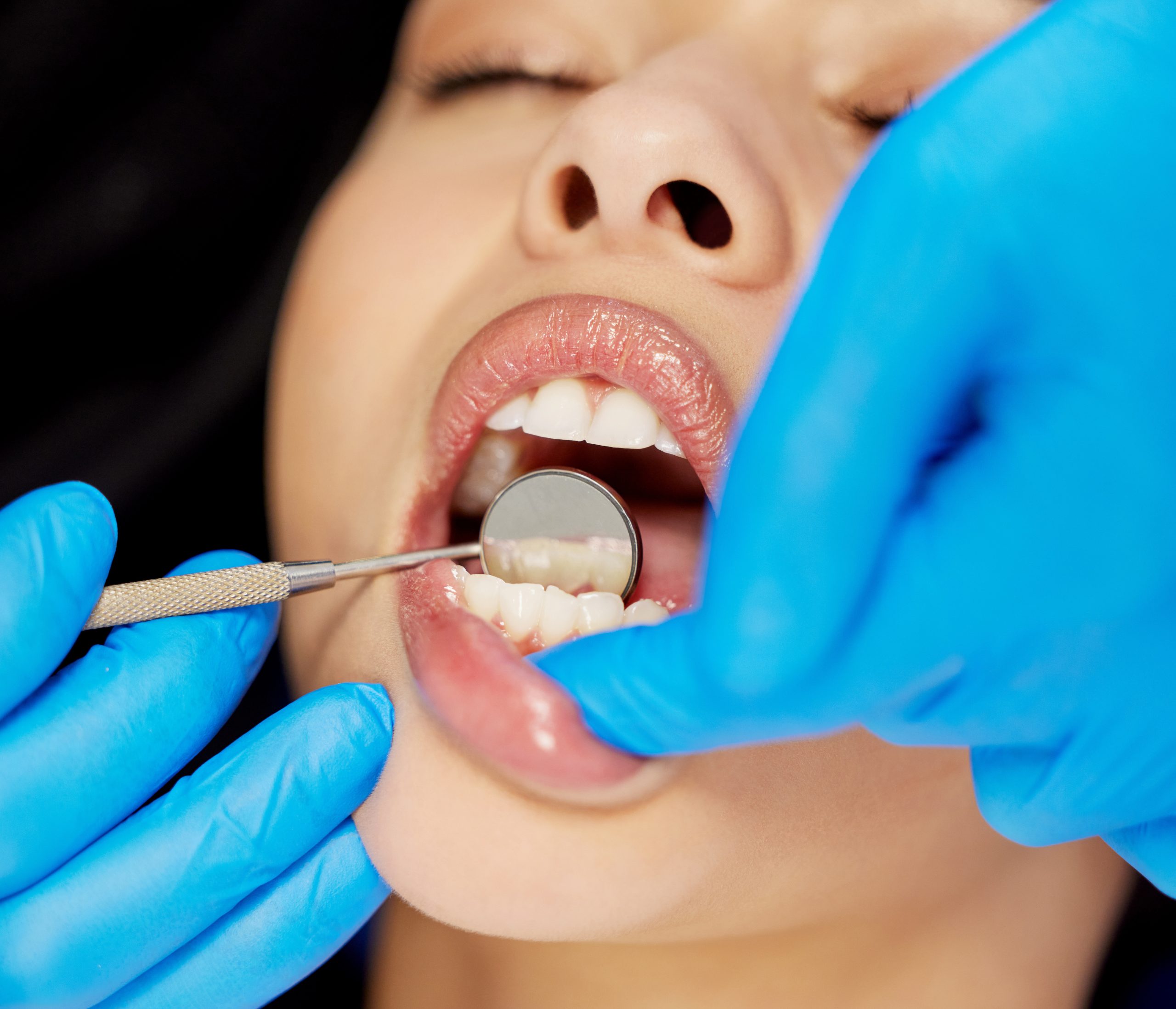 Woman, teeth and dentist with mouth mirror on patient for dental care, extraction or checkup at clinic. Closeup of female person at dentistry for tooth whitening, hygiene or cleaning of veneers